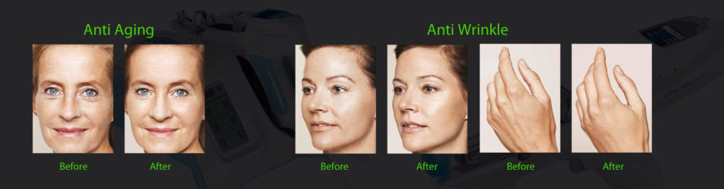 Anti-aging anti aging treatment