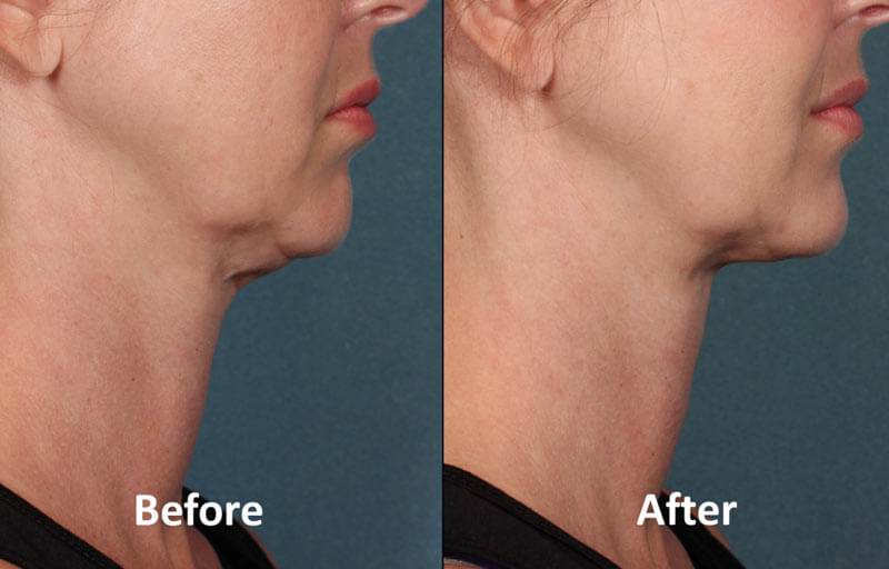 Best cellulite treatments lipo dissolve