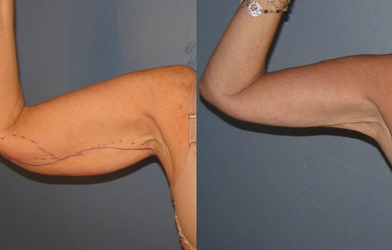 Best cellulite treatments smart lipo