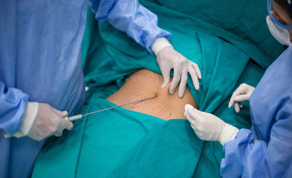 Cellulite treatment Aser Assisted Lipolysis