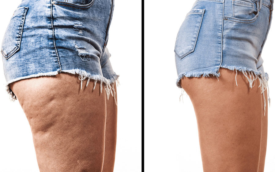 More facts about cellulite More facts about cellulite