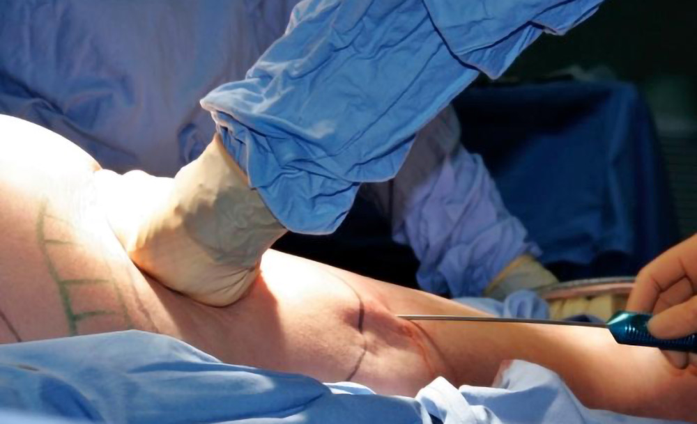 Cellulite treatment Liposuction Cellulite Treatment