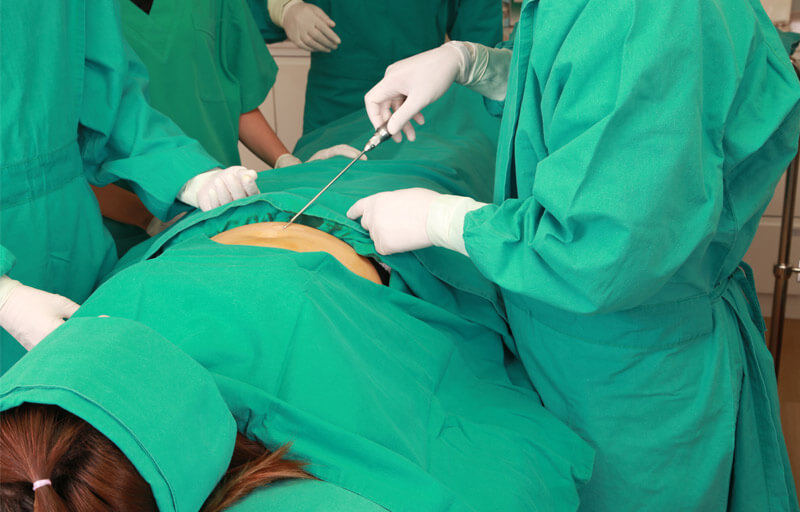 Best cellulite treatments lipo suction